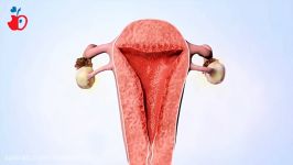 IUD یکی روش های جلوگیری بارداری