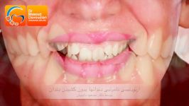 ارتودنسی نامرتبی دندانها بدون کشیدن دندان دکتر داودیان