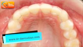 ارتودنسی دیمون بدون کشیدن دندان  دکتر مسعود داودیان