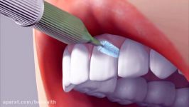 چگونه مسواک بین دندانی استفاده کنیم؟
