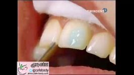 نگین دندان Tooth Piercing