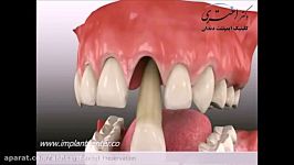 پیوند استخوان در ناحیه دندان تازه کشیده شده جهت ایمپلنت