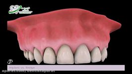 ایمپلنت بریج  پیشگیری
