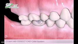 بازسازی تاج دندان دستگاه CAD CAM  پروتز