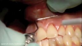 Esthetic Gum Surgery