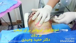 انجام لیزر لیپولیز برای بزرگی غبغب دکتر حمید وحیدی