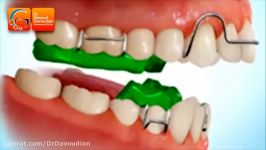 جلو آوردن فک پایین دستگاه فانکشنال  دکتر داودیان