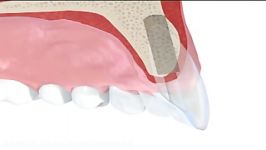 ایمپلنت دندان جلو بالا پیوند استخوان ساده