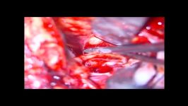 جراحی میکروسکپی انوریسم مغزی Anterior Com. Aneurysm Clipping