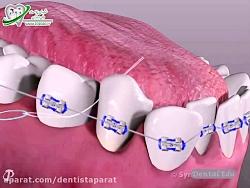 بهداشت دهان دندان برای افرادی ارتودنسی کرده اند