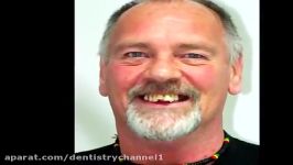 کشیدن دندان ها جایگزینی ایمپلنت جهت زیبایی