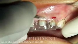 Anterior Esthetic Crown Lengthening