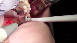 crown lengthening مولر اول بالا