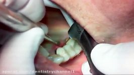 LASER CROWN LENGTHENING