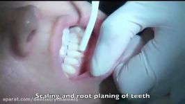 چراحی پیوند لثه Periodontal Tunneling Procedure