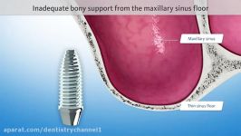 انیمیشن جراحی سینوس لیفت برای کاشت ایمپلنت