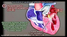 همه چیز درباره مرگ ناگهانی قلبی در ورزشکاران