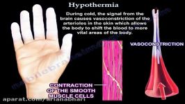 هیپوترمی  علل ، اثرات ، پیشگیری ، درمان 