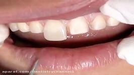 Porcelain Veneers Clinical Techniques for Exceptional