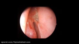 Tube removal and insertion