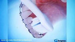 چگونگی بهداشت دهان ودندان پلاکهای ارتدنسی ثابت