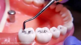 Class I Amalgam dental restoration carving