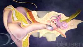 earcochlear implants