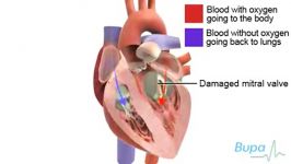 Heart valve replacement surgery