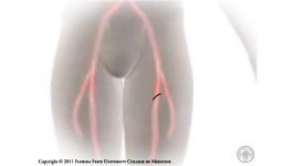 Percutaneous Coronary Intervention PCI