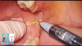 Local AnesthesiaTechnique inferior alveolar nerve block