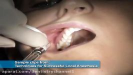 Local Anesthesia for Dental Professionals