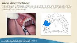 Middle Superior Alveolar Nerve Block