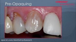 Composite Veneers