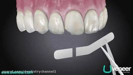 Composite Veneers Uveneer is the easiest and fastest