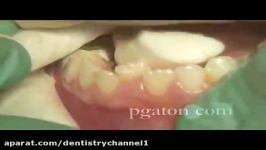 Stainless Steell Primary molar Crown