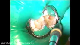 Partial pulpotomy using MTA