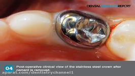 How to cement a stainless steel crown