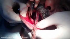 Vestibuloplasty Neuro Lip Swich