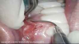 Vestibuloplasty Frenectomy