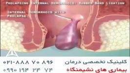 درمان بواسیرهموروئیدبارابربندwww.darmancolorectal.co