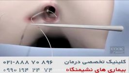 روش نوین درمان فیستول httpwww.darmancolorectal.com