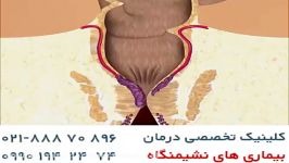 درمان بواسیر فیبر لیزرhttpwww.darmancolorectal.co