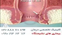 فیستول چیست httpwww.darmancolorectal.comfistula