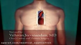 Robotic Mitral Valve Repair Surgery Animation