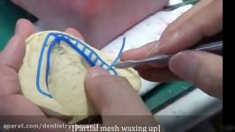 Partial mesh waxing up