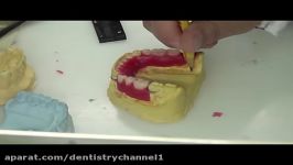 Temporary RPD quality check setting teeth