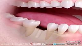 ایمپلنت دندانی،بهترین درمان جهت جایگزینی دندان کشیدنی