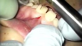 LABIAL FRENECTOMY