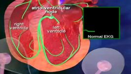 atrial fibrillation