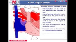 atrial septal defect